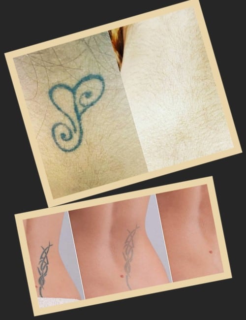 видалення тату до та після