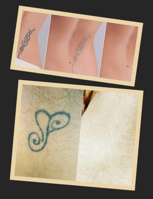 Результат видалення татуювань