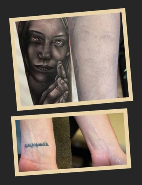 видалення тату фото результату