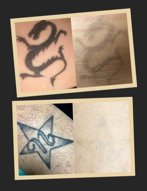 ефективність виведення тату