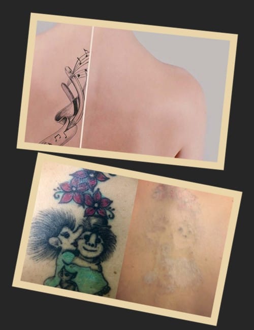 Видалення татуювання лазером