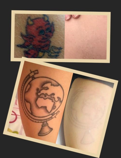 фото видалення тату