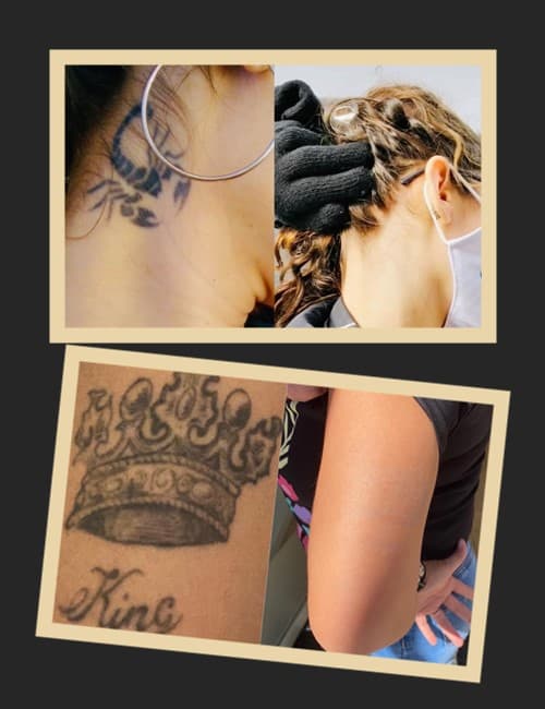 Різні методи видалення татуювань