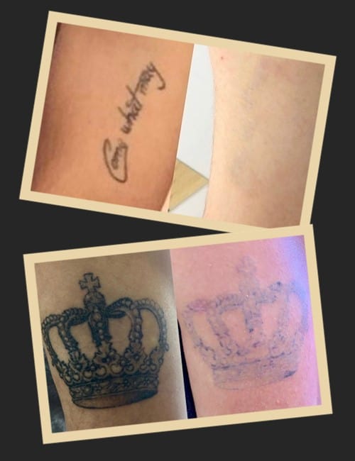 методи виведення тату