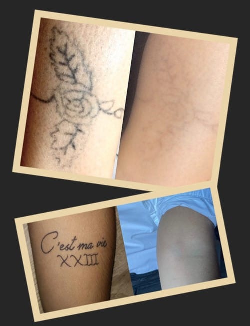 видалення тату методи