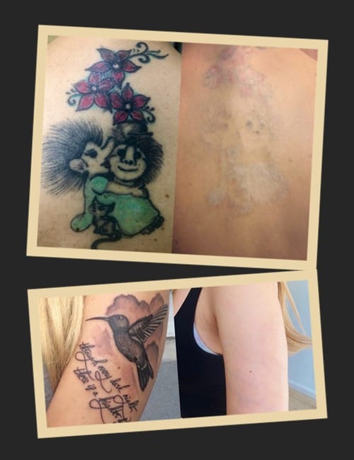 методи видалення татуювань