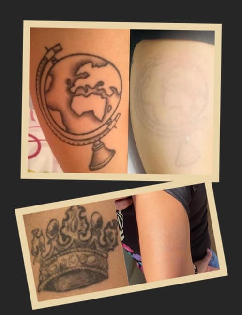 Альтернативні методи видалення татуювань