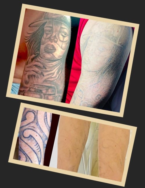 виведення татуювання