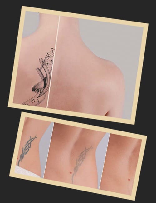 видалення тату лазером