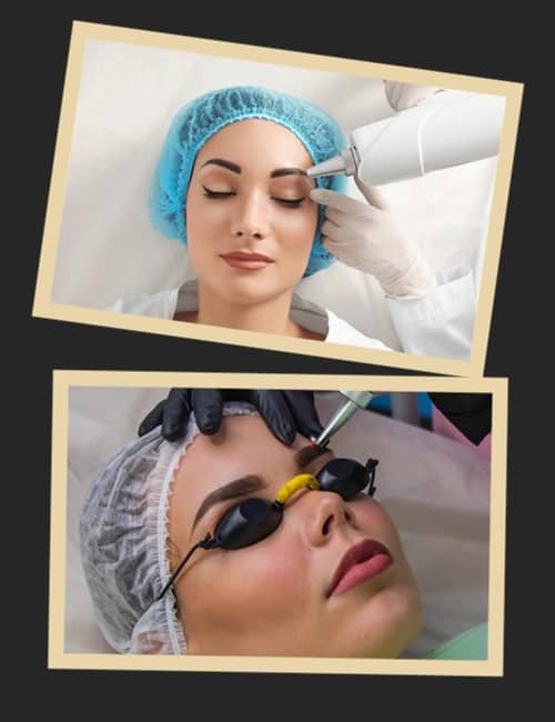 Видалення татуажу брів лазером: процес