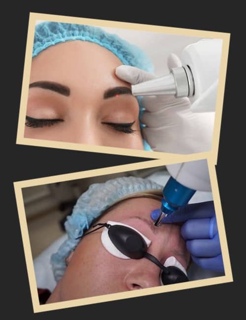 Лазерний метод видалення татуажу