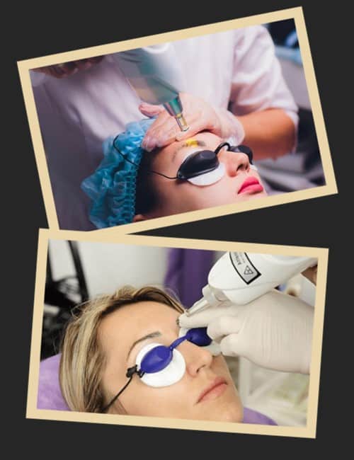 Лазерний спосіб видалення татуажу