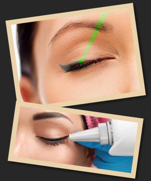 Видалення татуажу повік лазером відгуки