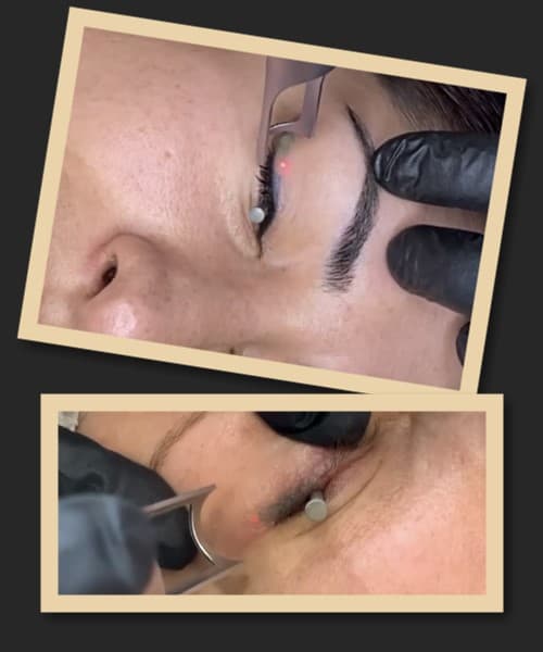 видалити татуаж повік