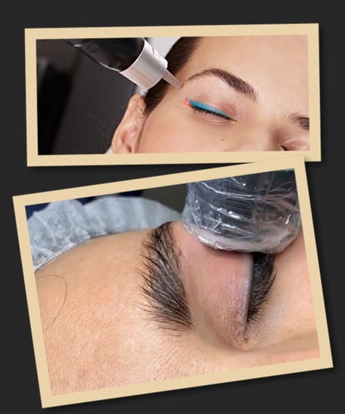 видалення татуажу повік