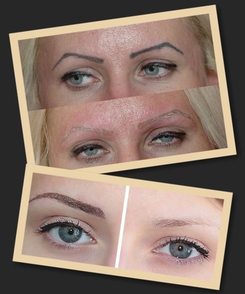 Видалення татуажу ремувером відгуки