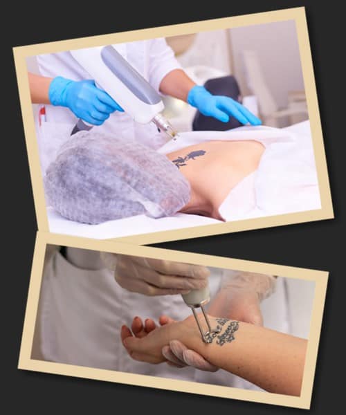 видалення тату київ відгуки