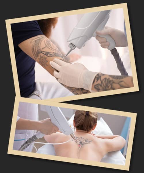 Видалення татуювання лазером відгуки