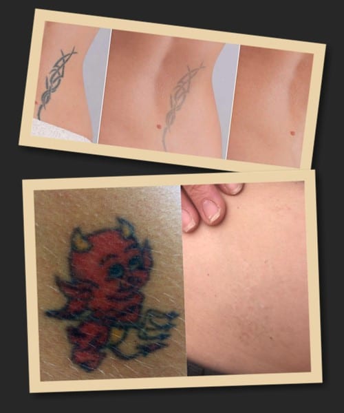 видалення татуювання ремувером відгуки