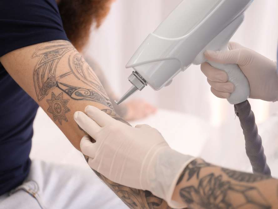 Як працює лазерне видалення тату