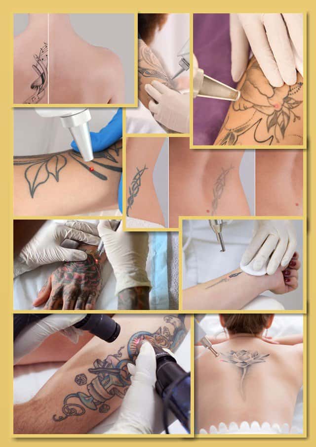 як видалити тату