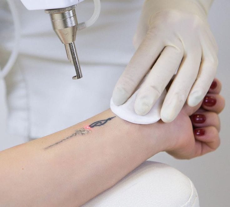 видалити татуювання лазером безпечно