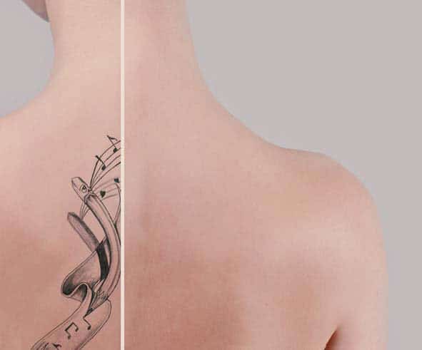 Як видалити татуювання