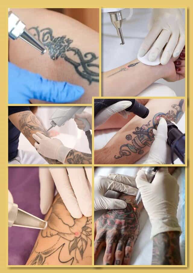 Лазерне видалення татуювань